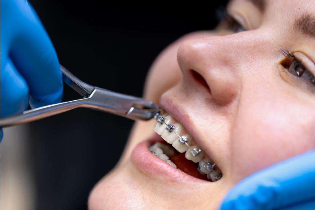 Fixed Braces